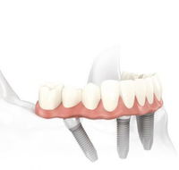 Specialist Oral Surgery - Dentists Hobart